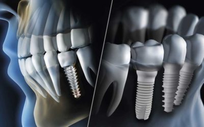 Dental Implants