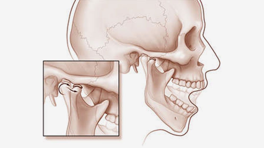 TMJ Disorder
