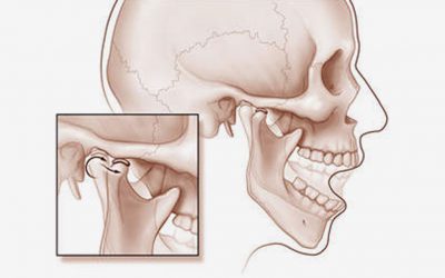 TMJ Disorder